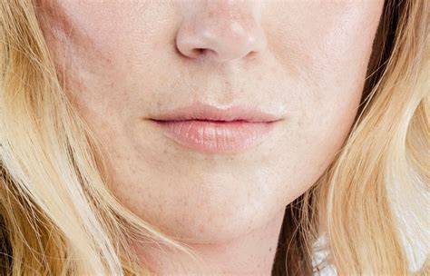 Lip Implants vs. Injections: Pros, Cons & Safety 